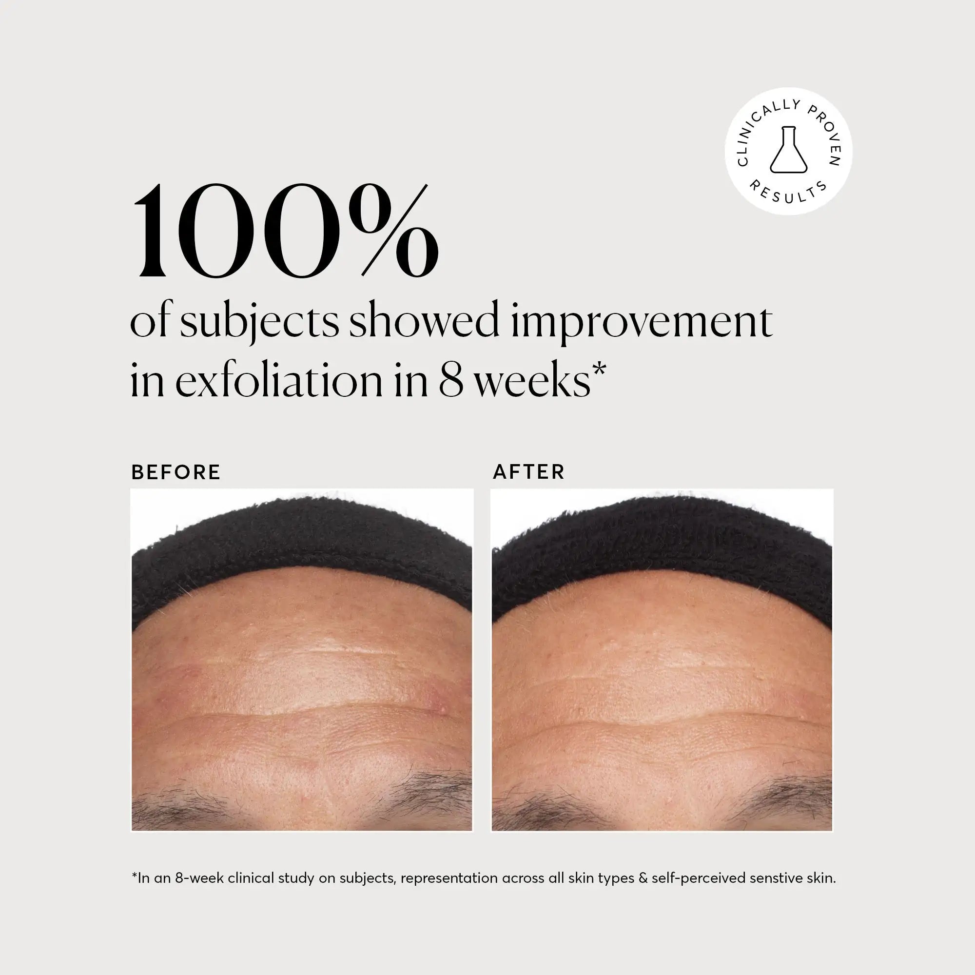 Azelaic Acid Derivative Complex 10% - Jumbo